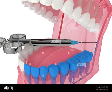 3d Renderizado De Mandíbula Humana Con Técnica De Bloqueo Del Nervio