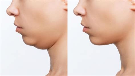 Premium Photo | Liposuction of double chin Cropped shot of woman's face ...