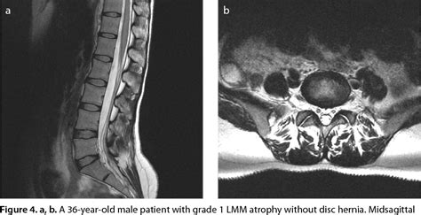 Table 1 From Age And Sex Based Distribution Of Lumbar Multifidus Muscle Atrophy And Coexistence