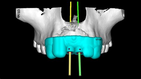 Gu A Quir Rgica Para Implantes Mayor Precisi N Y Menor Tiempo