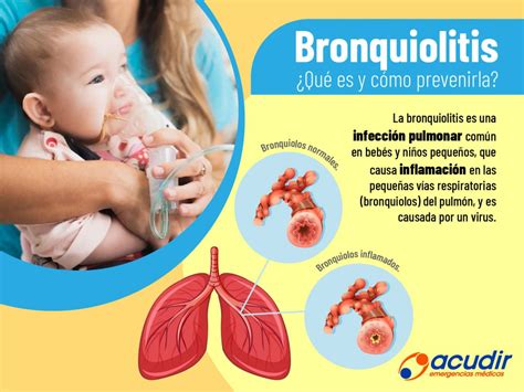 O que é Bronquiolite