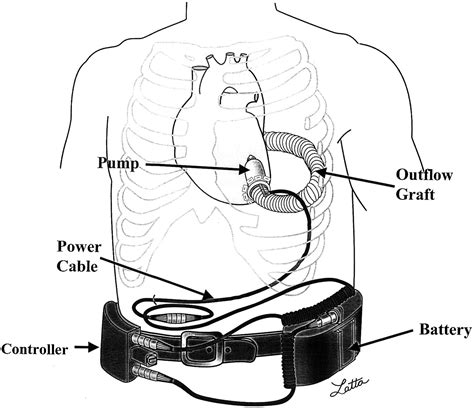 Initial Clinical Experience With The Jarvik 2000 Implantable Axial Flow