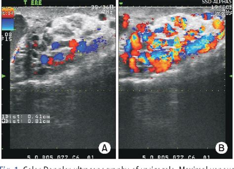 Figure 1 From Efficacy Of Scrotal Doppler Ultrasonography With The Valsalva Maneuver Standing