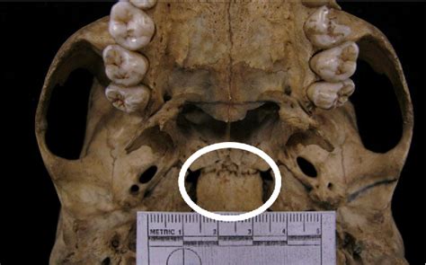 Table 1 From Spheno Occipital Synchondrosis Examining The Degree Of Fusion In A South African