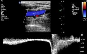 Venous Ultrasound: Indications and Brief Ultrasound Protocol