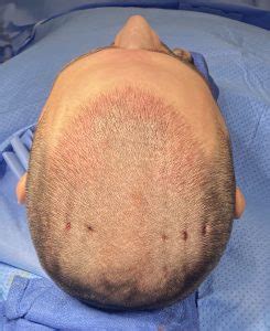 Plastic Surgery Case Study The Trearment Of Scalp Cutis Verticis