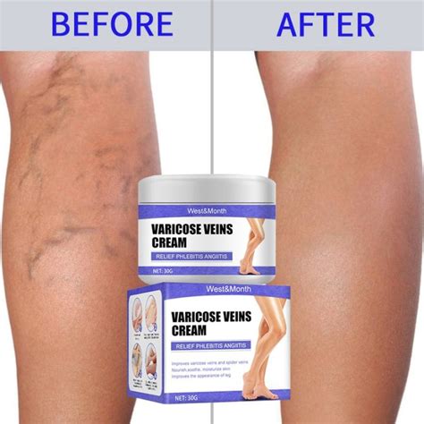 Effective Varicose Veins Relief Cream Relieve Vasculitis Phlebitis