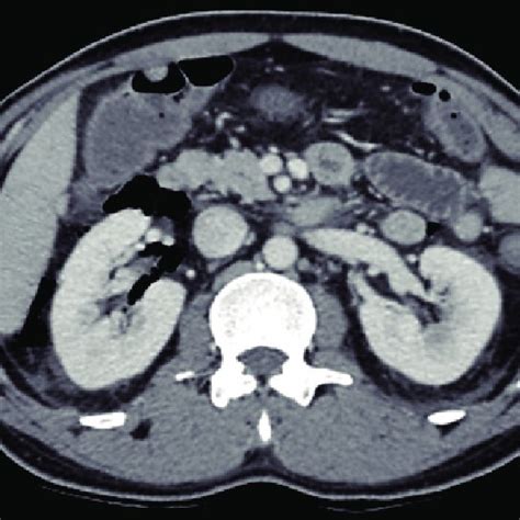 Abdominal Computed Tomography Scan Showing Retroperitoneal Air