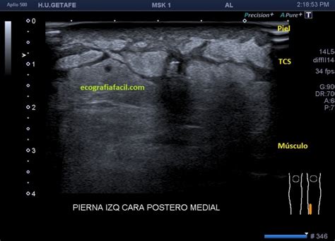 193 Edema Y Absceso En Ecografía Semiología Habitual Ecografía Fácil