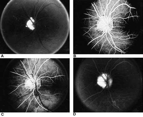 Optic nerve drusen - American Academy of Ophthalmology