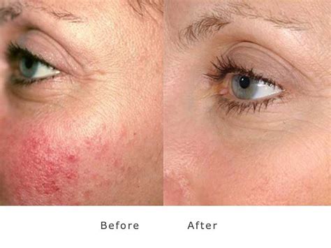 Rosacea And Acne Treatment At My Face Aesthetics Laser Clinic Bolton