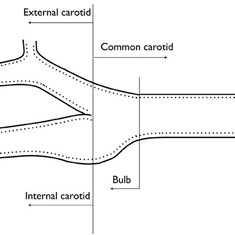 Schematic showing the common, internal and external carotid arteries ...