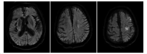 Brain Magnetic Resonance Imaging With Diffusion Weighted Imaging