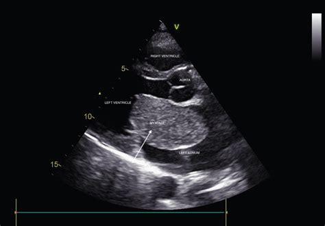 A Large Left Atrium Myxoma Presenting As Positional Pre Syncope