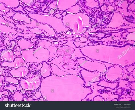 Synovial Sarcoma Histology Image Analyzed By Stock Photo 2238805355 ...