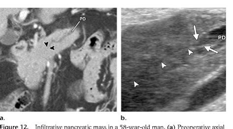 Figure 3 From Intraoperative Ultrasonography Of The Pancreas Semantic Scholar