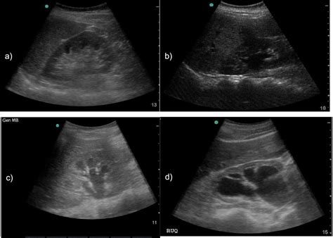 Mild Hydronephrosis Ultrasound