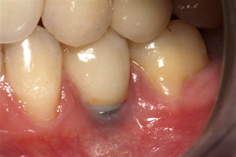 Peri Implantitis Y Mucositis Radiologia