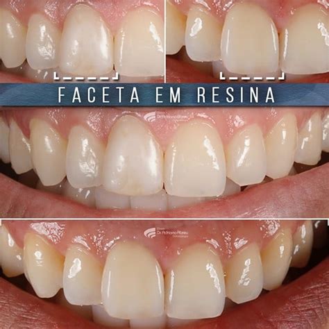 Facetas De Resina O Que S O E Qual Sua Indica O Est Tica