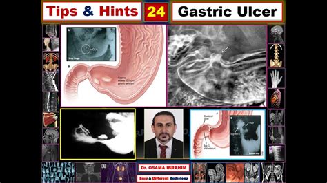 Benign Vs Malignant Gastric Ulcers Tips And Hints 24 Hamptons Sign Vs