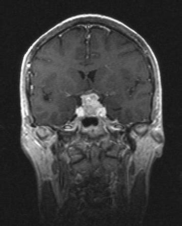 Pituitary Metastasis From Breast Cancer Image Radiopaedia Org