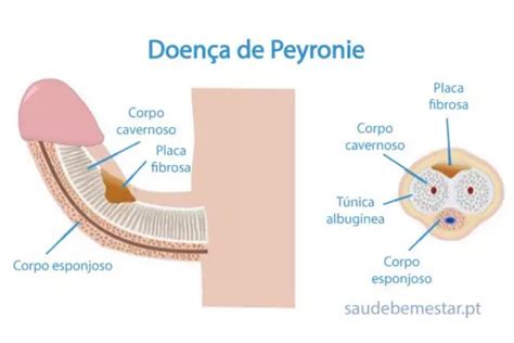 Curvatura Peniana Doen A De Peyronie Dr Antonio Tavares