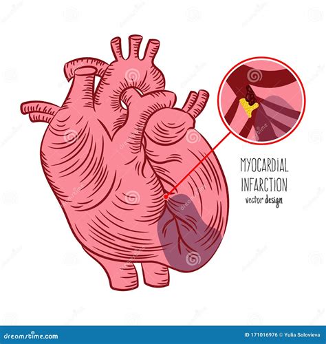 Tudes De M Decine De Crise Cardiaque De Plan D Infarctus Du Myocarde