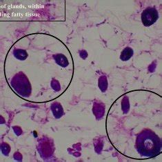 Dmba Induced Breast Cancer At The Neck Region Of Rats Treated With Dmba