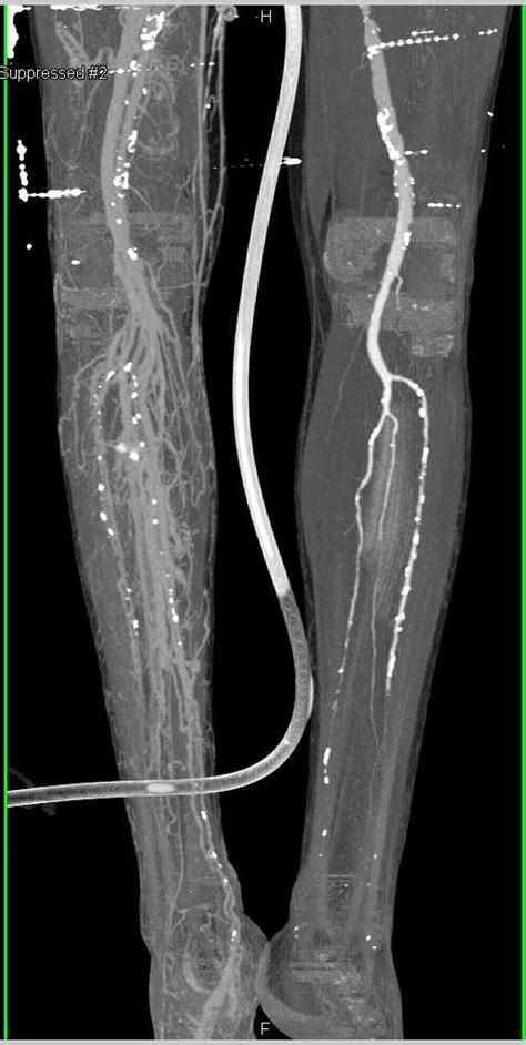 Femoral Peroneal Bypass