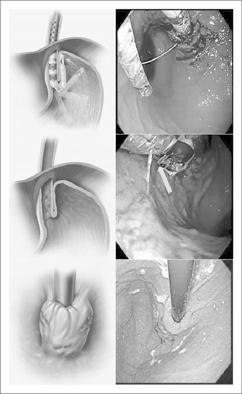 Transoral Incisionless Fundoplication Creates A 2708 Anterior Partial