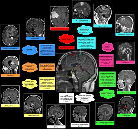 Cns Tumors Pediatricncc