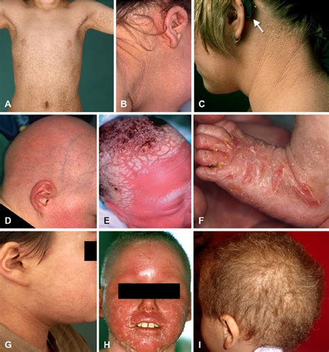 Fig Clinical Examples Of Syndromic Forms Of Ichthyosis Figure