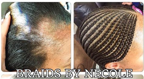 14 Extraordinary Alopecia Camouflage Cornrows By Braids By Necole Black Hair Information