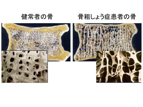 骨粗鬆症