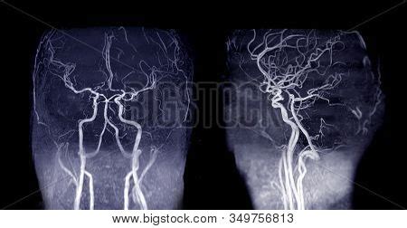 Mra Brain Magnetic Image & Photo (Free Trial) | Bigstock