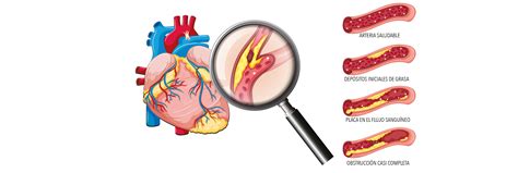 Las Enfermedades Cardiovasculares Son La Primera Causa De Muerte En El