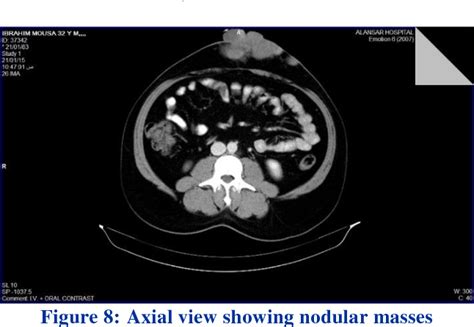 Figure 8 From A Rare Large Anterior Abdominal Wall Dermatofibrosarcoma