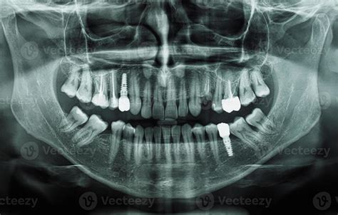 Orthopantomograph Panoramic Image Radiograph Of Teeth 10134530 Stock