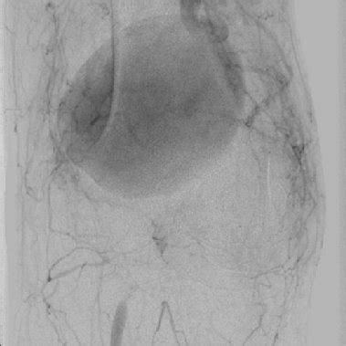 Computed Tomography Angiography CTA Showing Saphenous Vein Graft