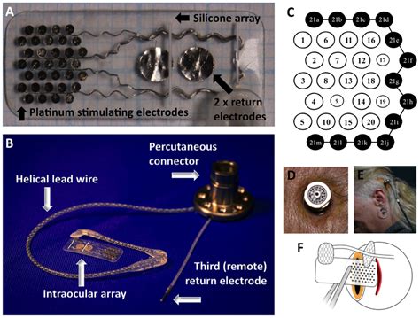 The Intraocular Electrode Array Of The Suprachoroidal Device A And Download Scientific