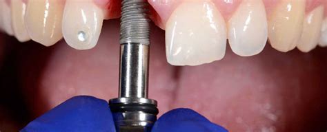 Cost Of Two Front Teeth Implants In India