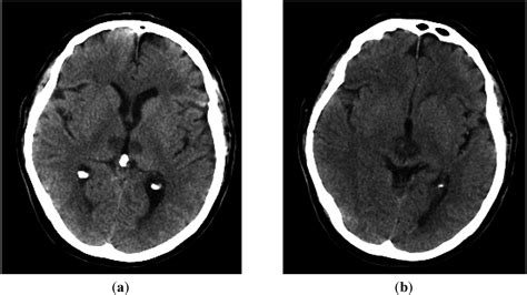 Jcm Free Full Text A Case Of Midbrain And Thalamic Infarction