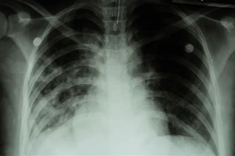 Tuberculosis Pulmonar Tb La Radiografía De Tórax Muestra