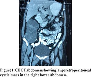 Primary Isolated Retroperitoneal Hydatid Cyst A Case Report