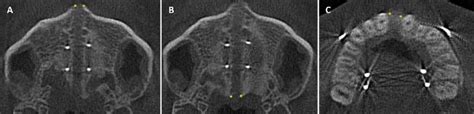 Axial Cbct Sections Showing A The Intermaxillary Suture Ans B The Download Scientific