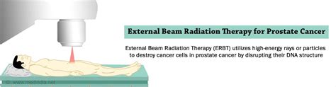 External Beam Radiation Therapy for Prostate Cancer - Frequently Asked Questions