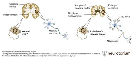 Alzheimer's disease brain with amyloid plaque and neurofibillary ...