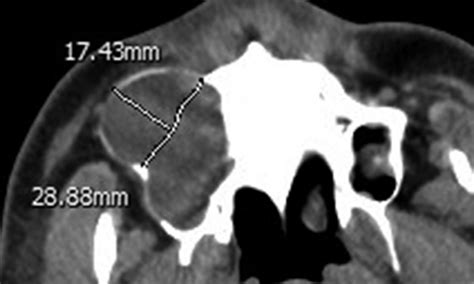 Axial CT Showing An Odontogenic Keratocyst Occupying The Right