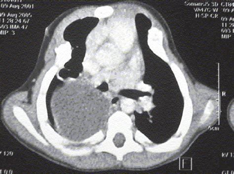 Ct Scan Chest Showing Well Defined Posterior Mediastinal Cyst