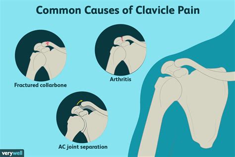 Right Vs Left Clavicle